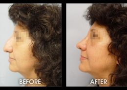 Nose Sculpting Surgery