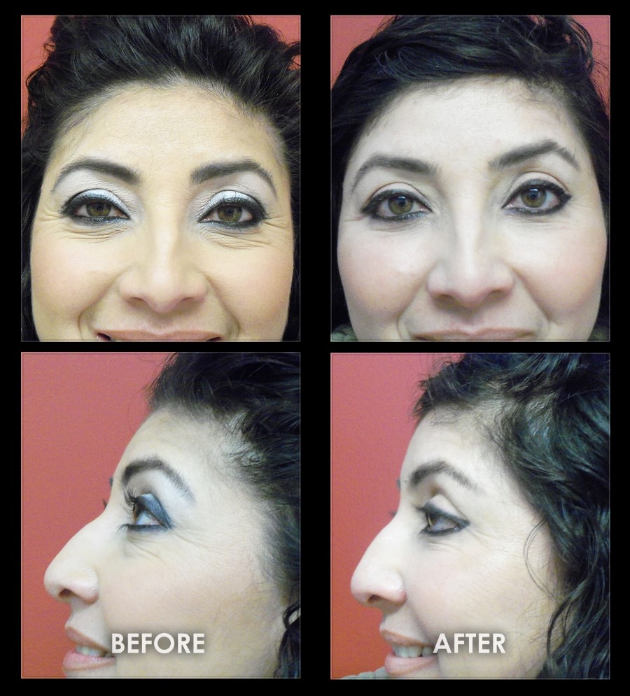 Crows Feet Surgery Before After Photos