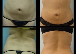 Precision Liposculpture