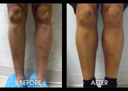 Calf Implants