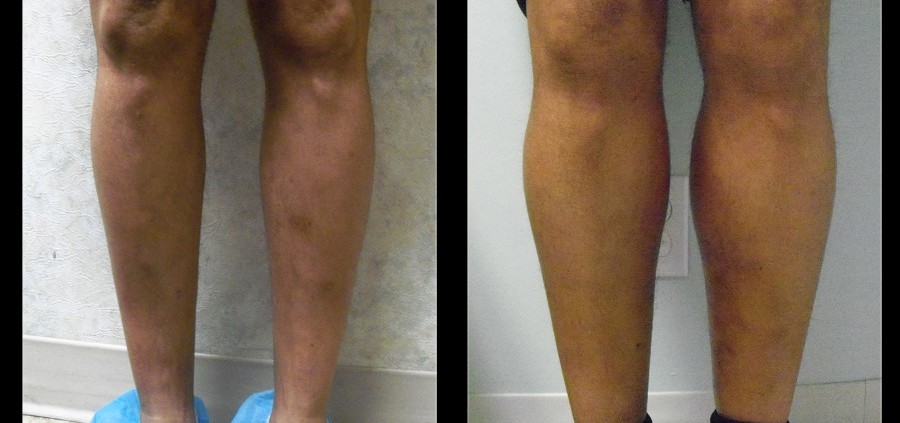 Calf Implants