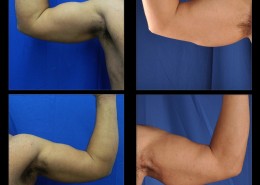 Bicep Implants