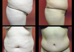 Tummy Tuck