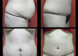Tummy Tuck
