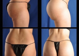 Buttock Augmentation | Implants