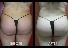 Hip / Thigh Augmentation