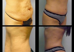 Tummy Tuck
