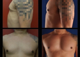 Pectoral Implants