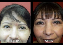 Crows Feet Surgery Before After Photos
