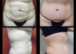 Tummy Tuck