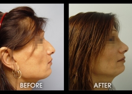 Nose Sculpting Surgery