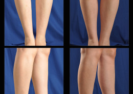 Calf Implants