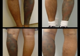Calf Implants