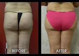 Hip / Thigh Augmentation