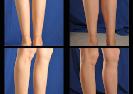 Calf Implants