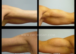Bicep Implants