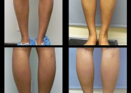Calf Implants
