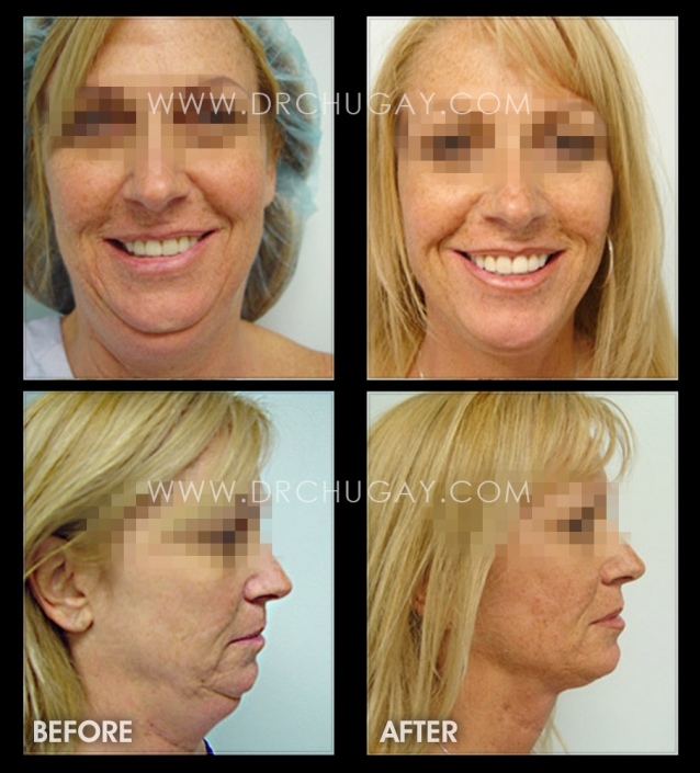 Vertical Facelift Surgery Before and After Galleries, Long Beach