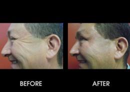Crows Feet Surgery Before After Photos