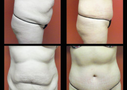 Tummy Tuck