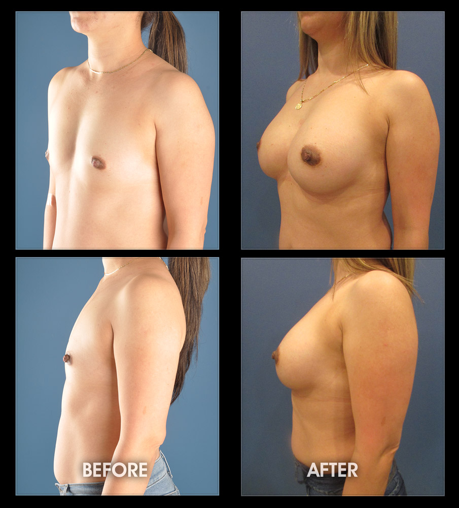 Breast Augmentation picture