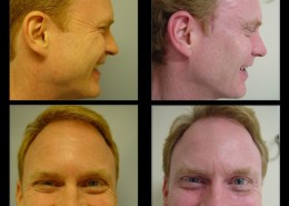 Crows Feet Surgery Before After Photos