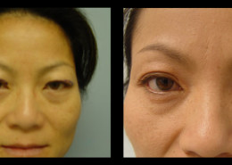 Eyelid Surgery