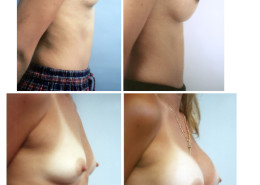 Breast Augmentation