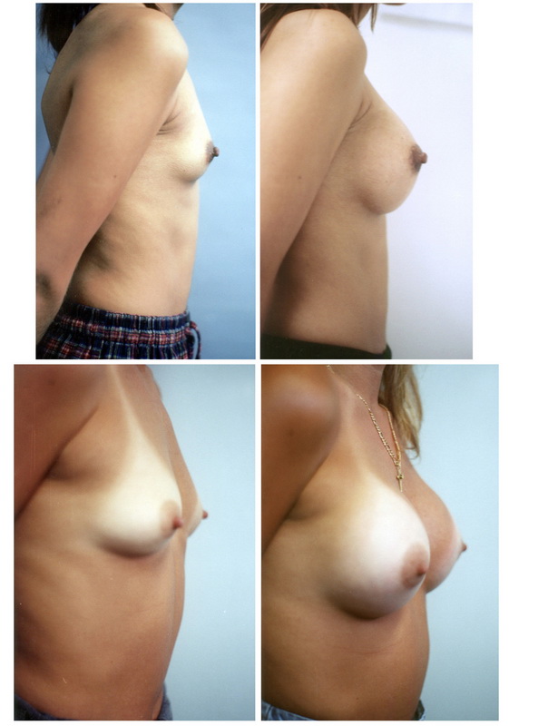 Breast Augmentation