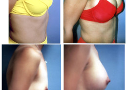Breast Augmentation