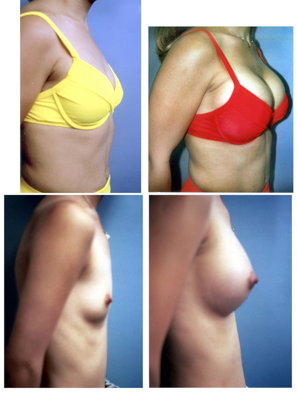Breast Augmentation