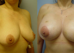 Breast Augmentation