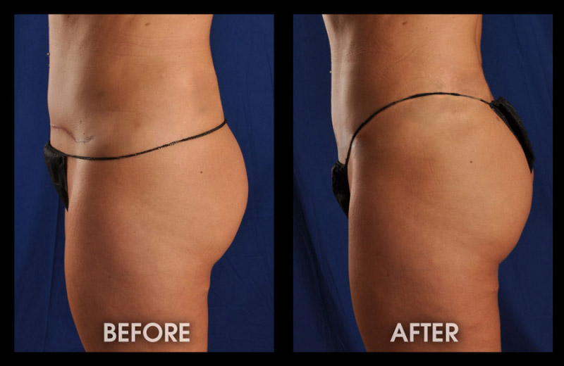 Buttock Augmentation With Liposuction & Fat Grafting