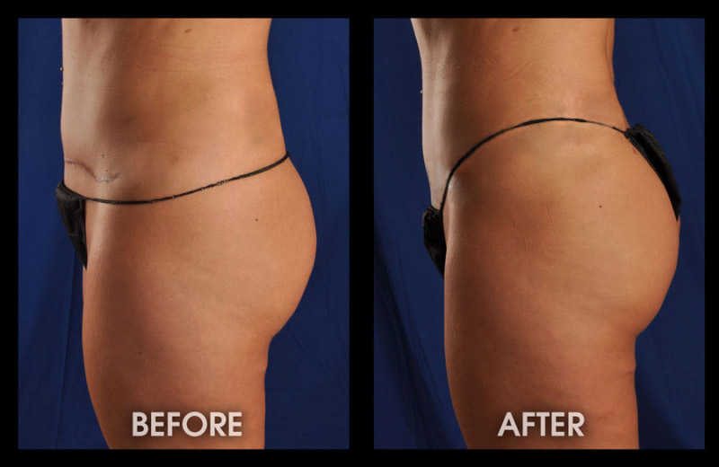 Buttock Implants - Butt Implant, Long Beach, Orange County