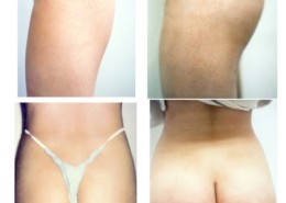 Buttock Implants