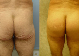 Buttock Implants