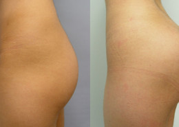 Buttock Implants