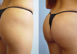 Buttock Implants