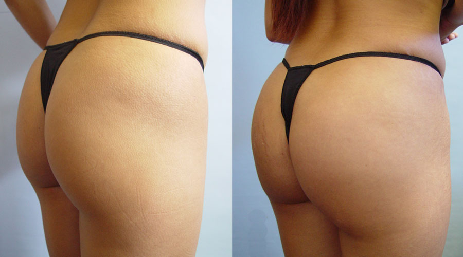 Buttock Implants