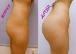 Buttock Augmentation