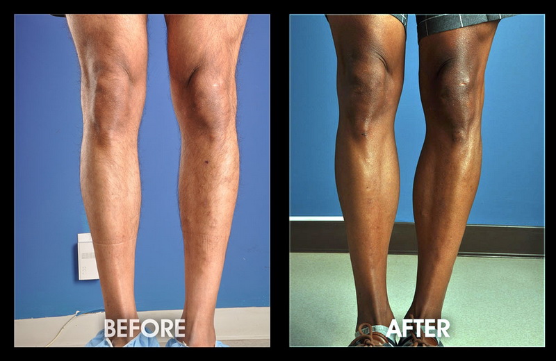 Calf Implant Images Calfs Augmentation Chugay Cosmetic Surgery