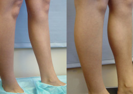 Calf Implants