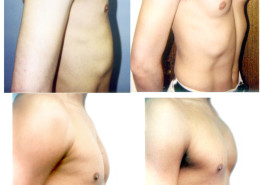 Pectoral Implants