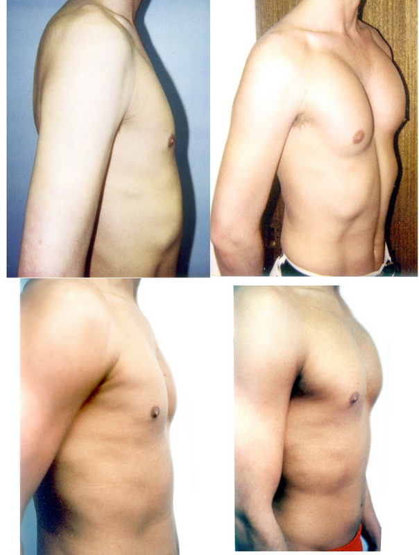 Pectoral Implants