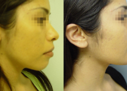 Chin Sculpting Surgery