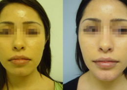Chin Sculpting Surgery