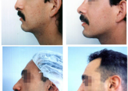 Nose Sculpting Surgery