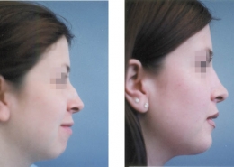 Nose Sculpting Surgery
