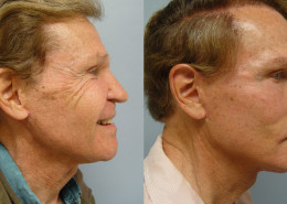 Crows Feet Surgery Before After Photos Feet