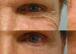 Crows Feet Surgery Before After Photos